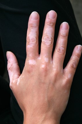 White spots on hand- Vitiligo
